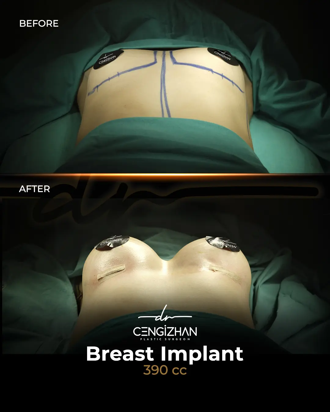 Breast Implant Before and After by Dr. Cengizhan Ekizceli