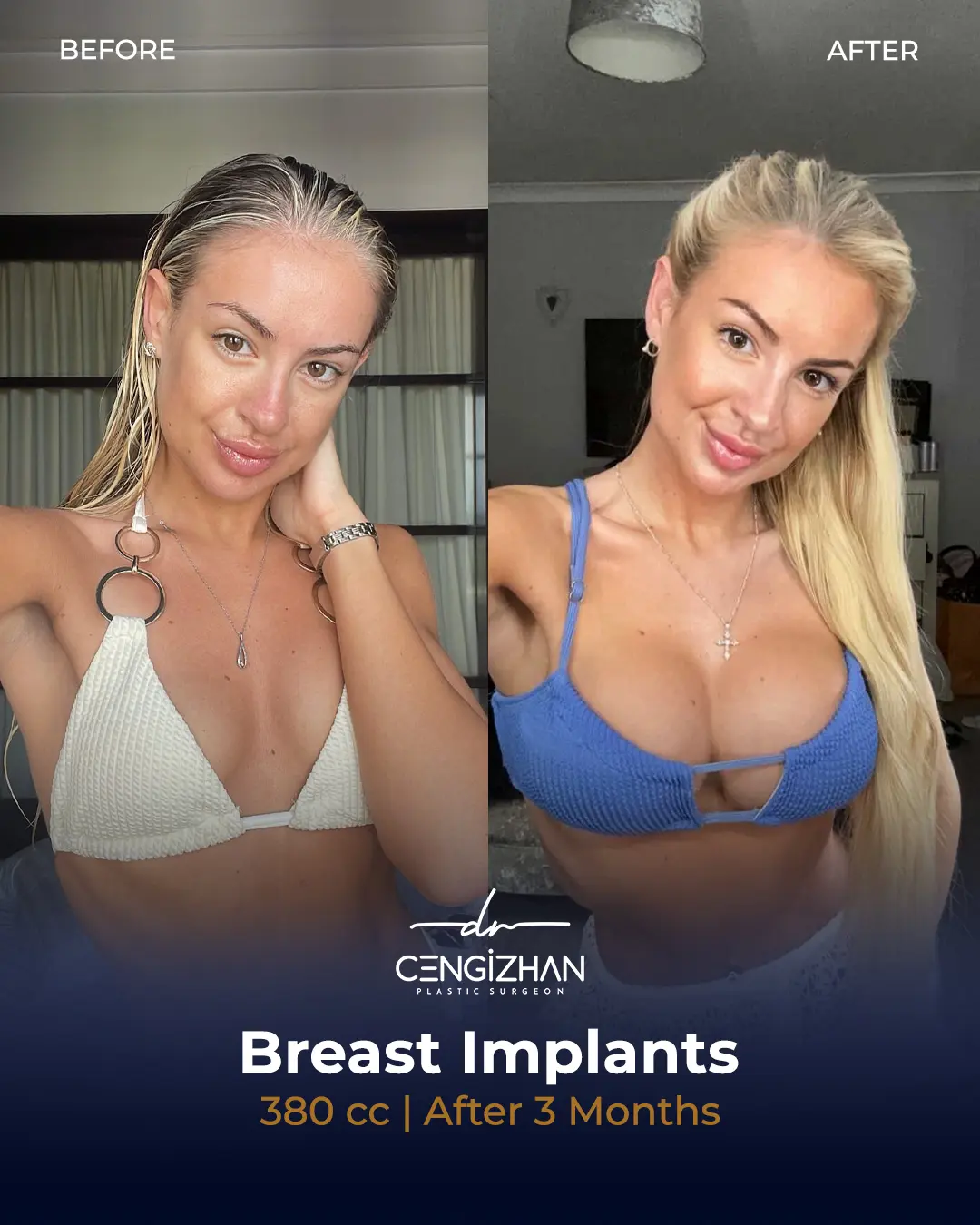 Breast Implant Before and After by Dr. Cengizhan Ekizceli