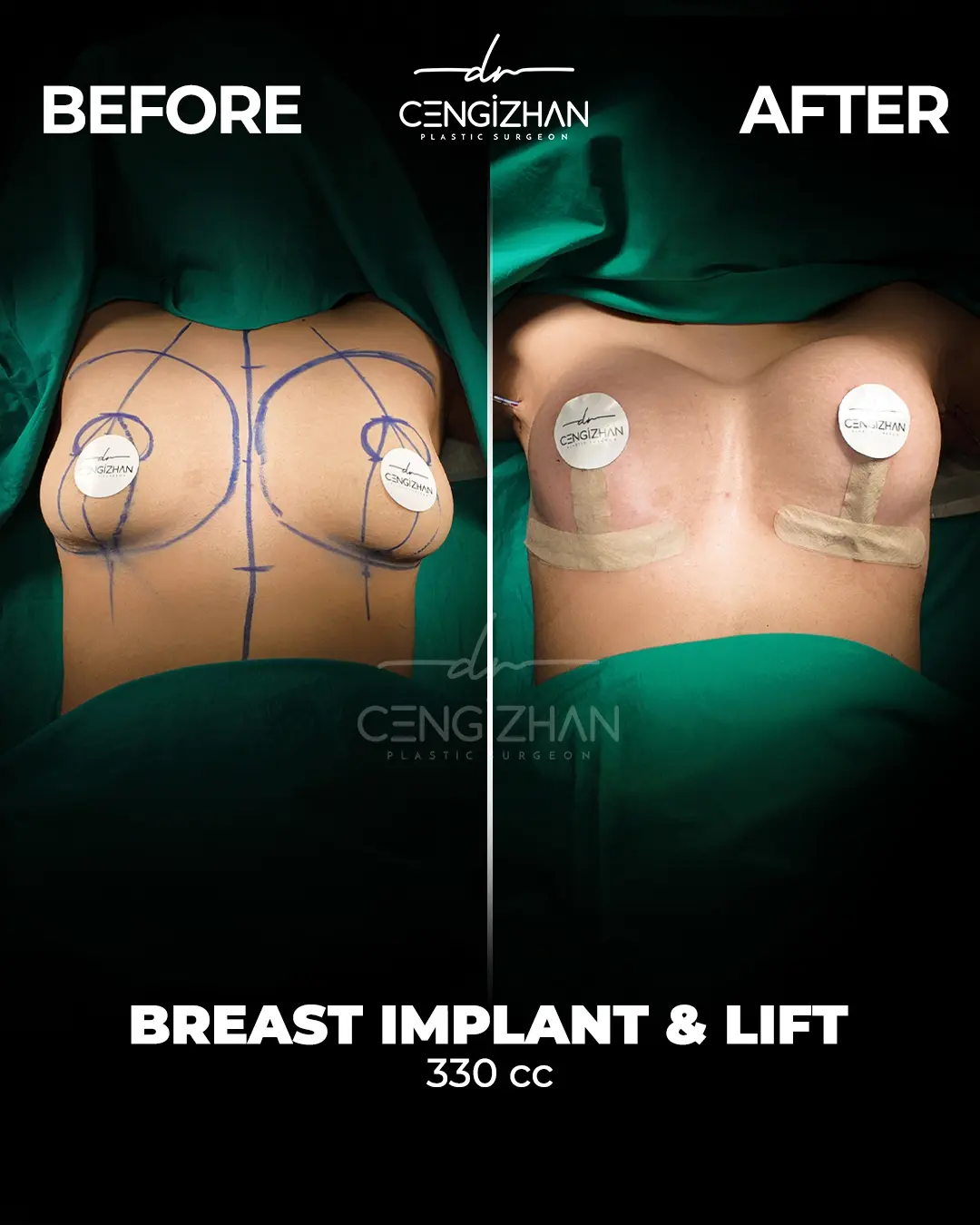 Breast Implant Before and After by Dr. Cengizhan Ekizceli