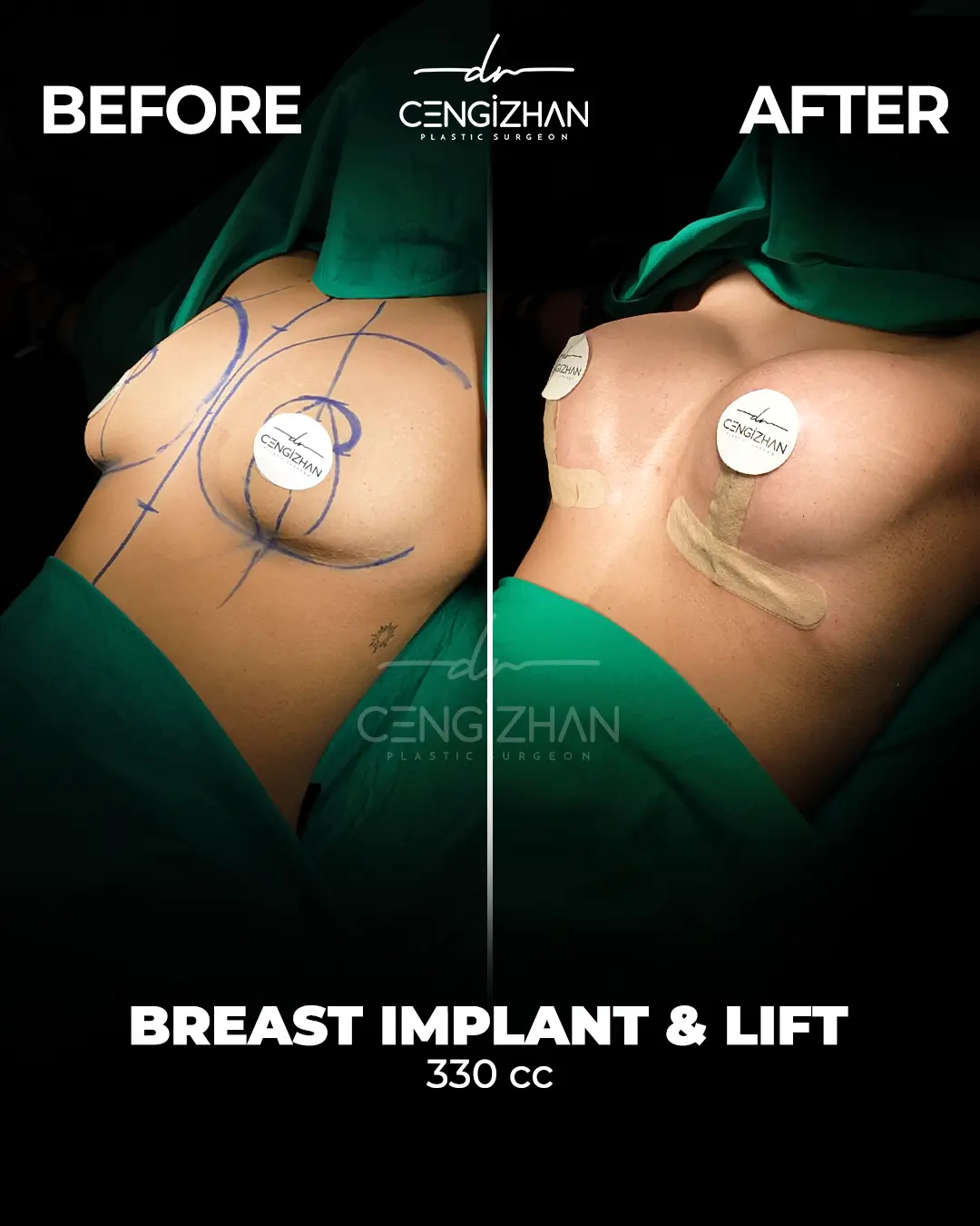 Breast Implant Before and After by Dr. Cengizhan Ekizceli