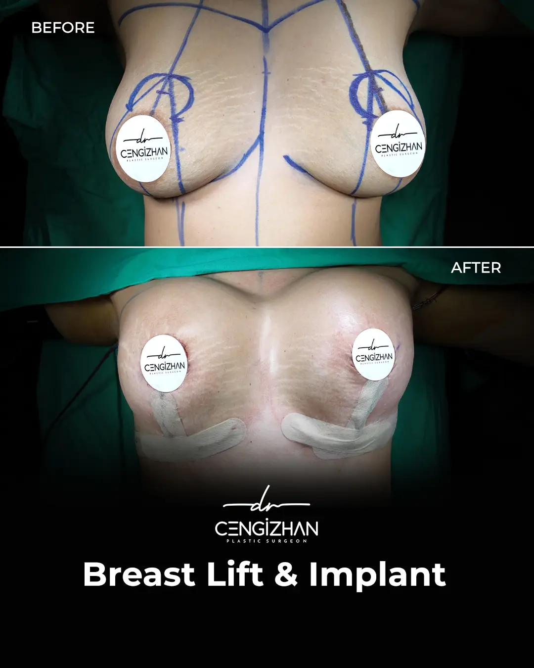 Breast Implant Before and After by Dr. Cengizhan Ekizceli