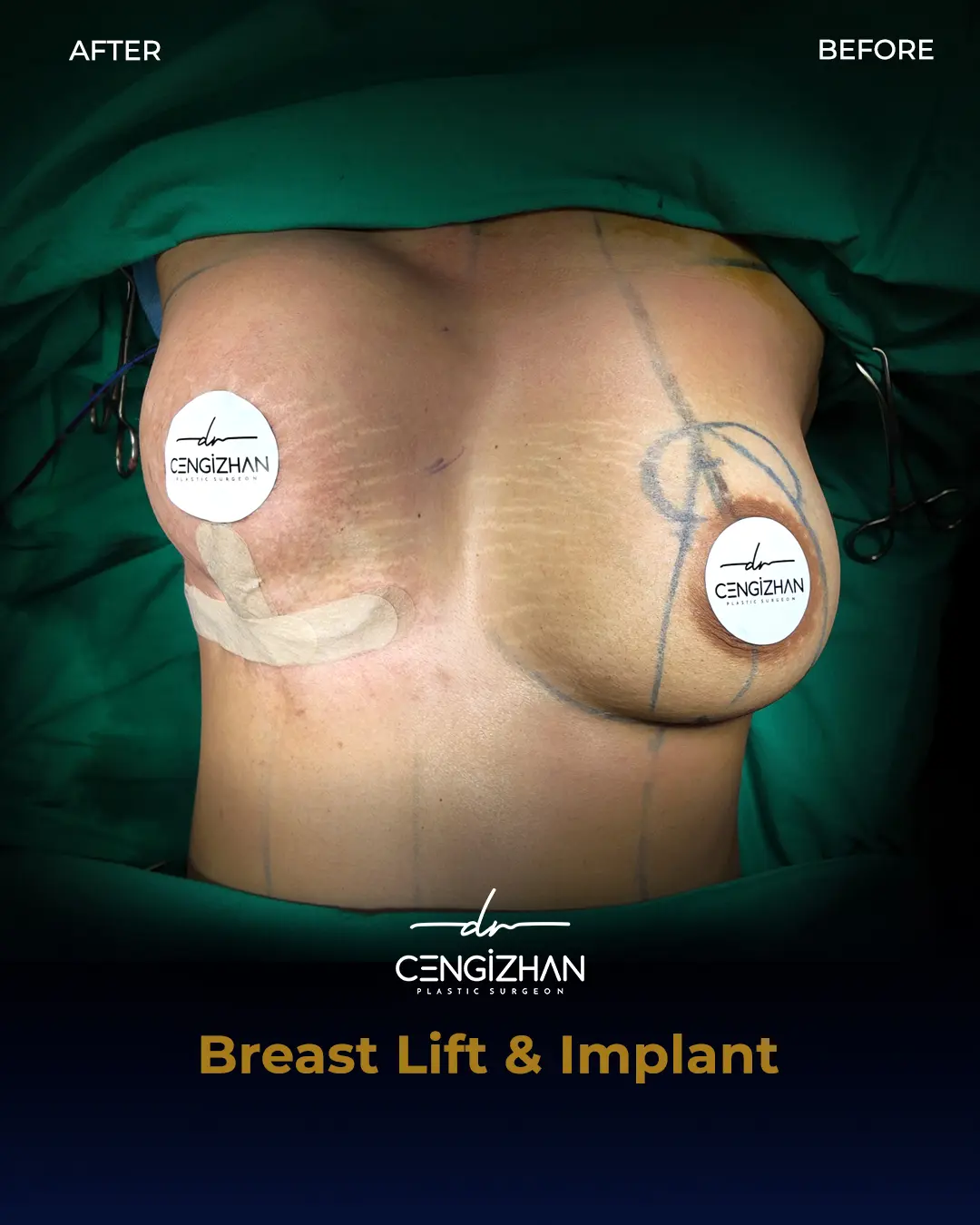 Breast Implant Before and After by Dr. Cengizhan Ekizceli