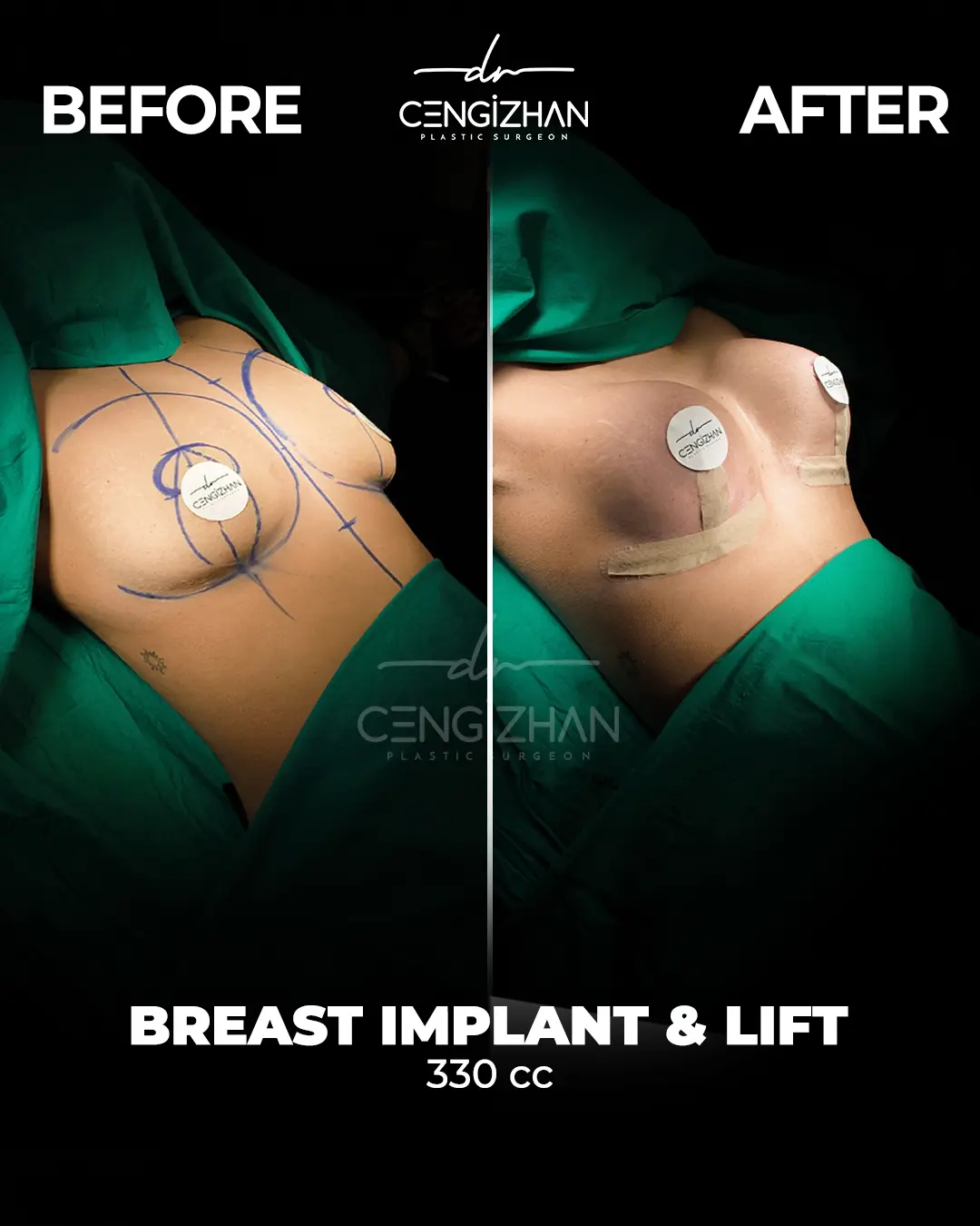 Breast Implant Before and After by Dr. Cengizhan Ekizceli