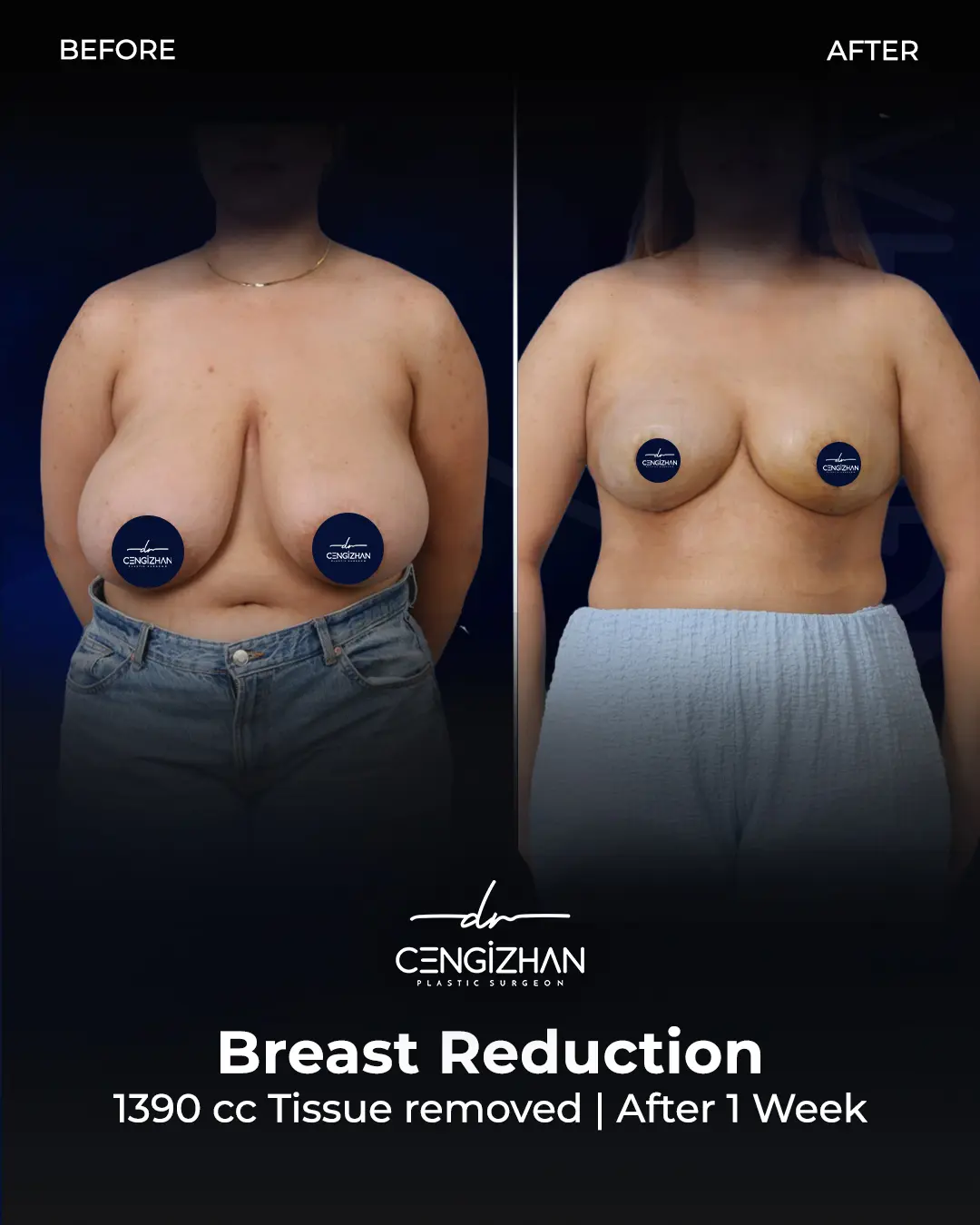 Breast Reduction Before and after photo by Dr. Cengizhan Ekizceli