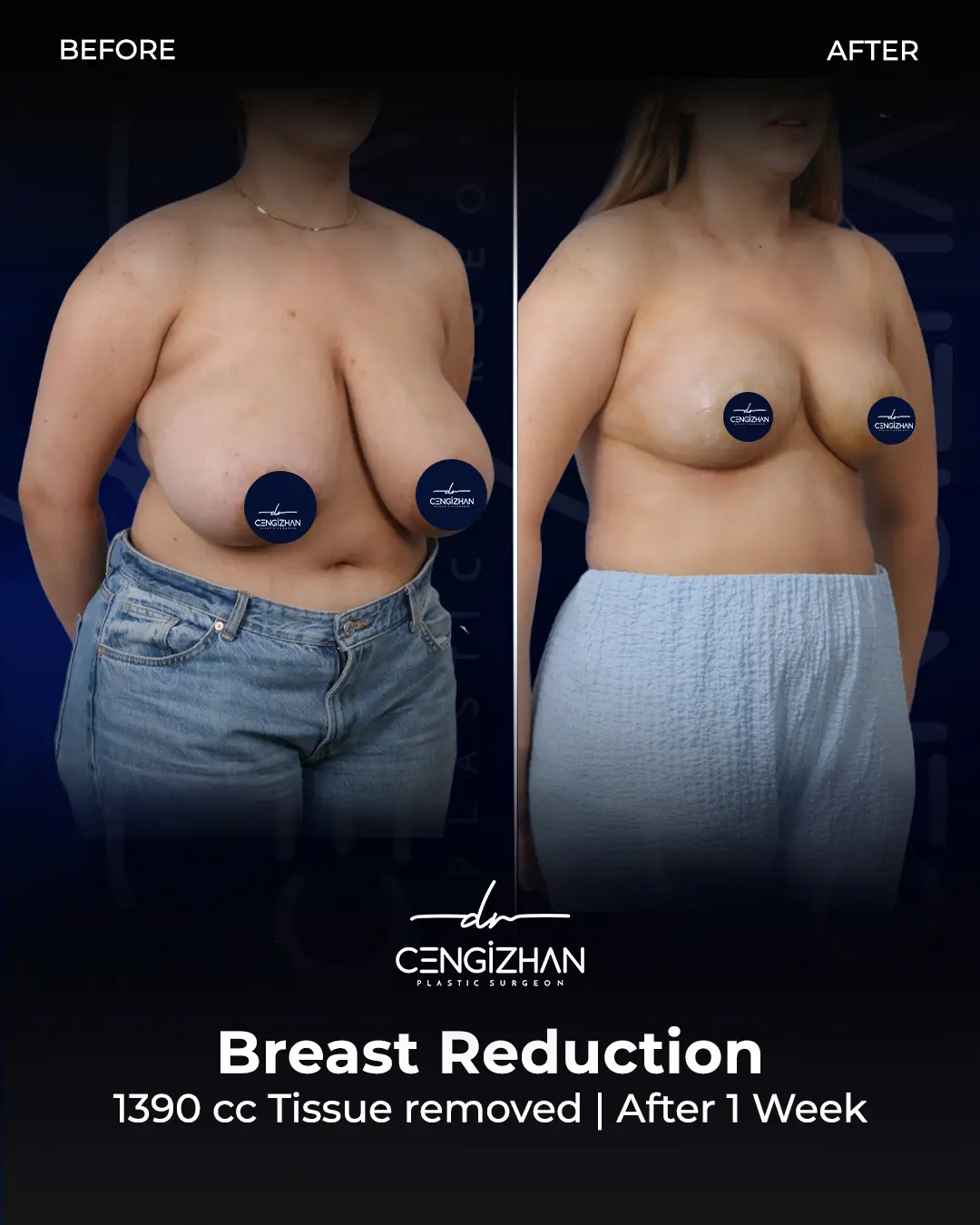 Breast Reduction Before and after photo by Dr. Cengizhan Ekizceli