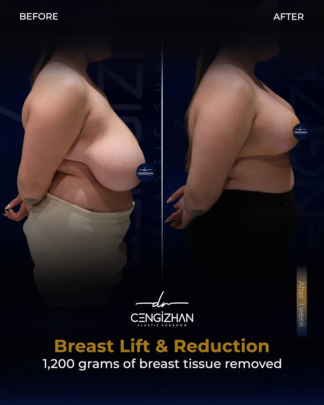 Breast Lift and Reduction Before and after photo by Dr. Cengizhan Ekizceli
