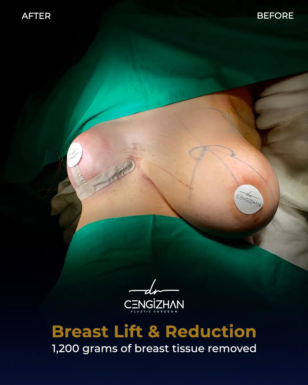 Breast Lift and Reduction Before and after photo by Dr. Cengizhan Ekizceli