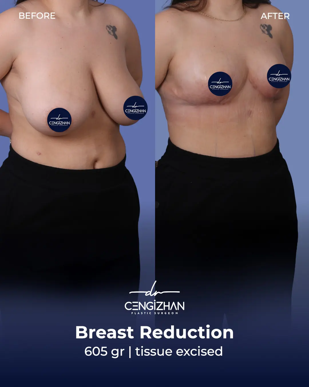 Breast Reduction Before and after photo by Dr. Cengizhan Ekizceli
