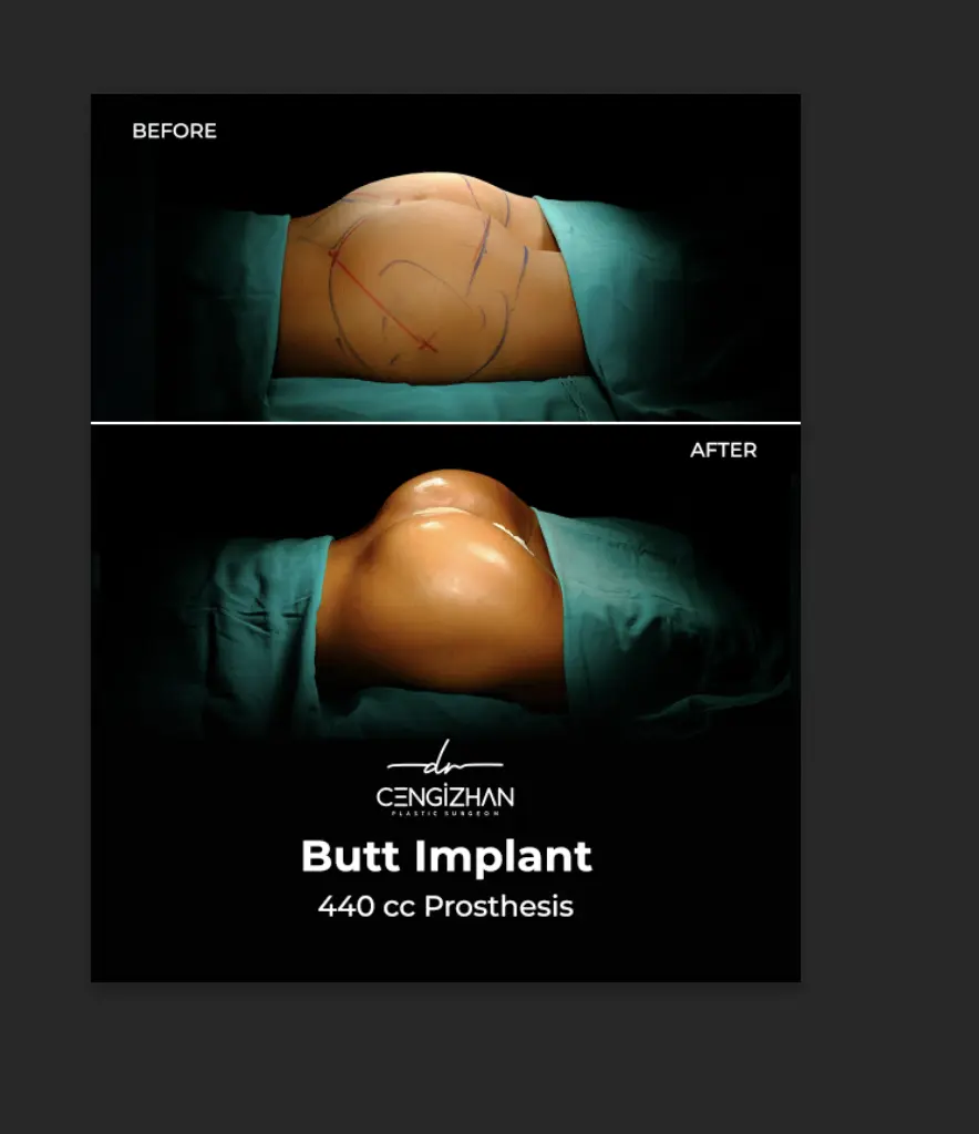 Butt Implants - Before and After - Real Transformation by Dr. Cengizhan Ekizceli