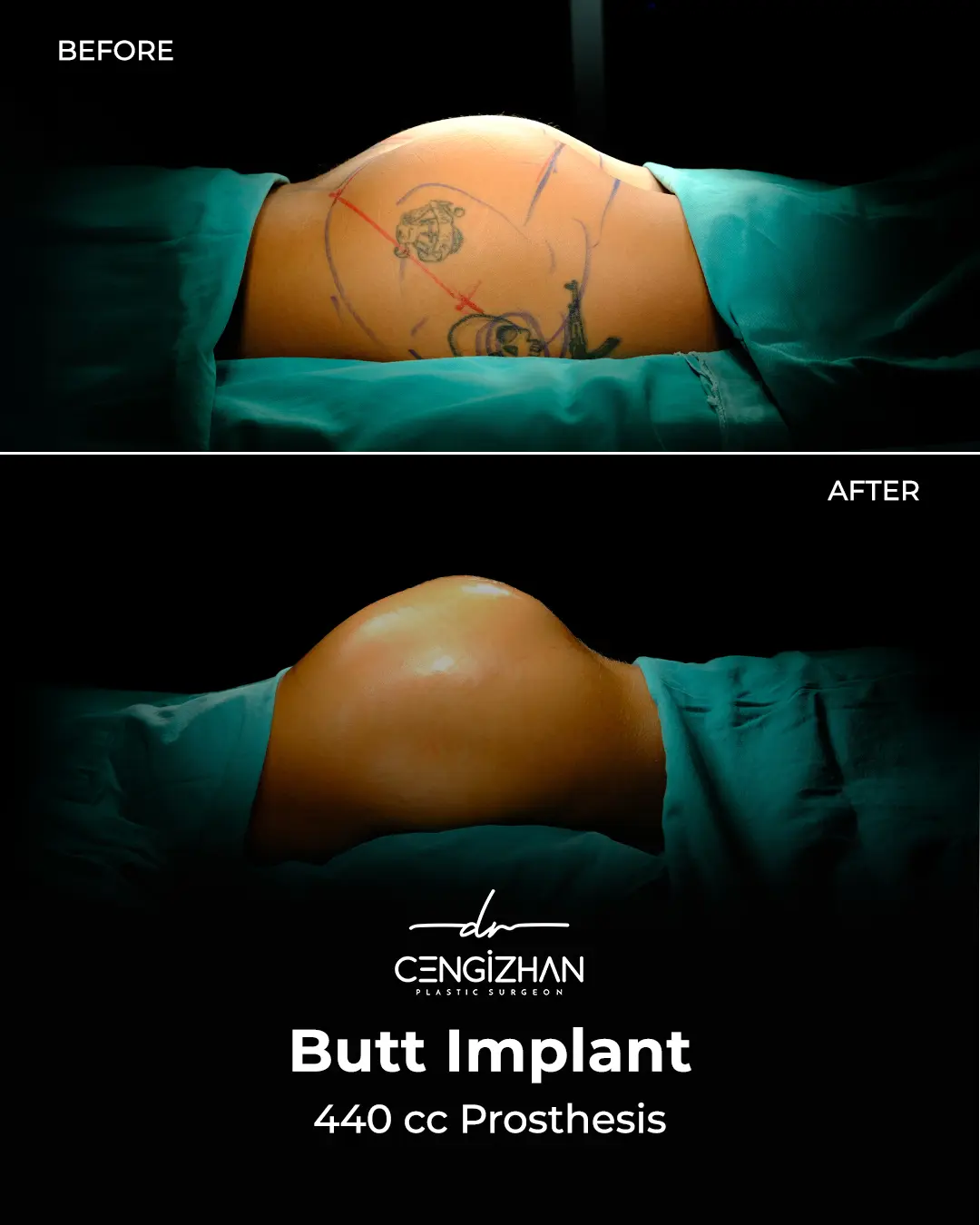 Butt Implants - Before and After - Real Transformation by Dr. Cengizhan Ekizceli