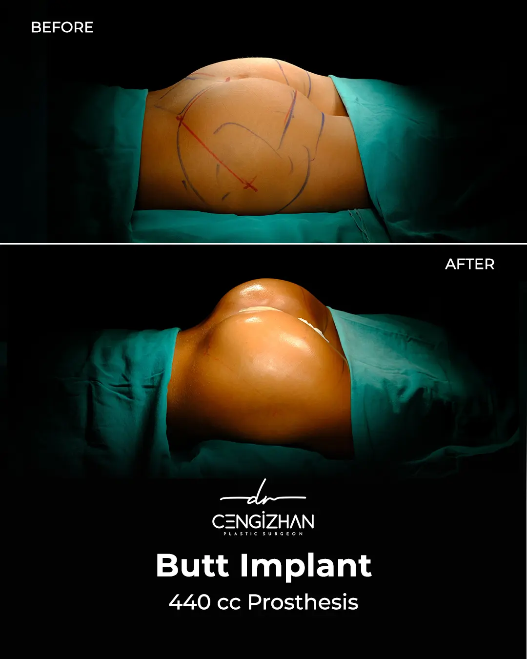 Butt Implants - Before and After - Real Transformation by Dr. Cengizhan Ekizceli