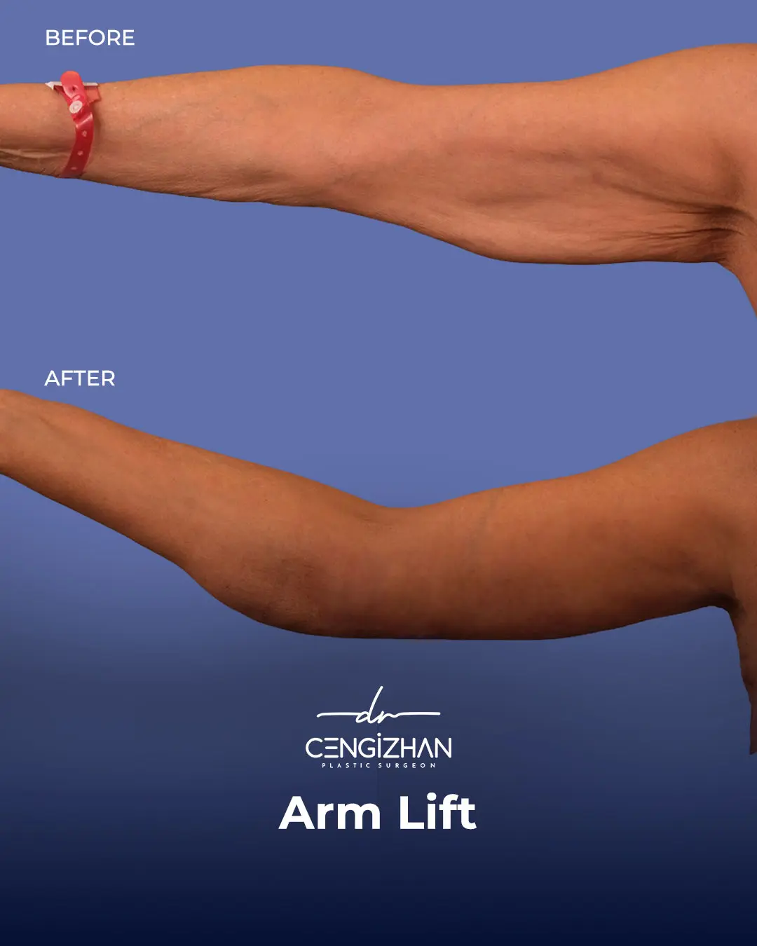 Arm Lift Results Before and After by Dr. Cengizhan Ekizceli