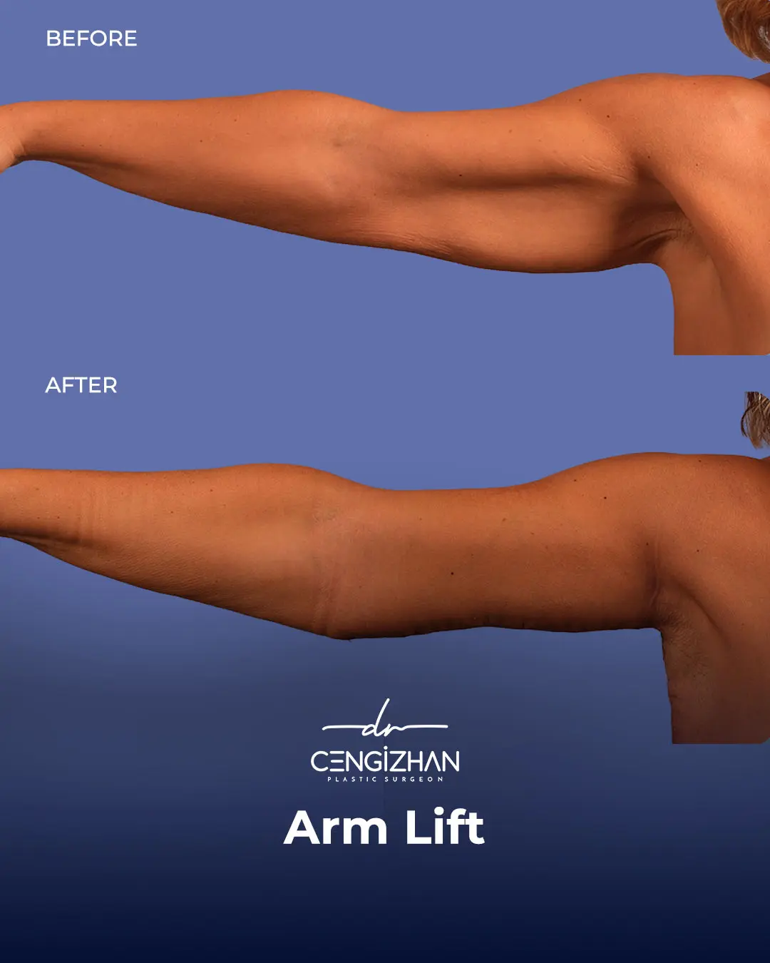 Arm Lift Results Before and After by Dr. Cengizhan Ekizceli