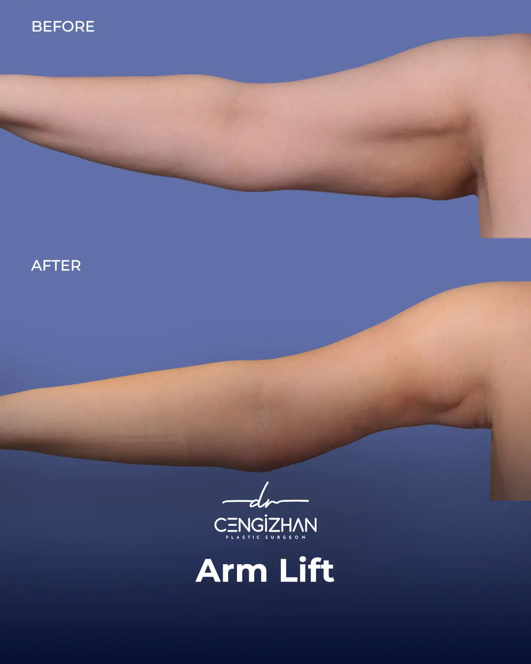 Arm Lift Results Before and After by Dr. Cengizhan Ekizceli