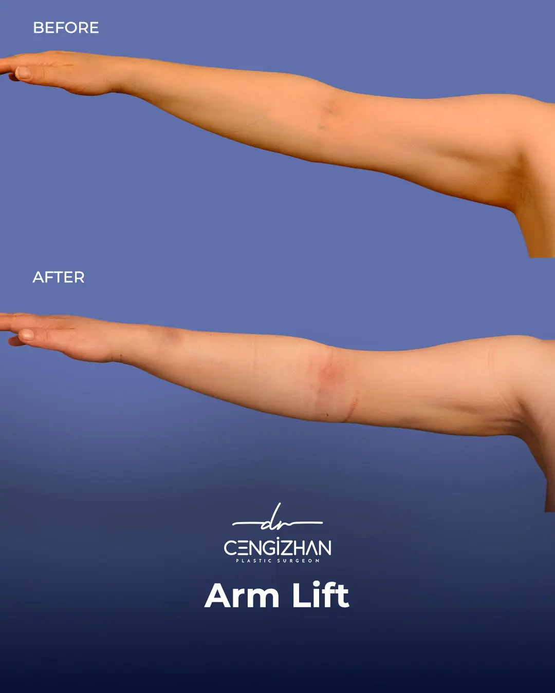 Arm Lift Results Before and After by Dr. Cengizhan Ekizceli