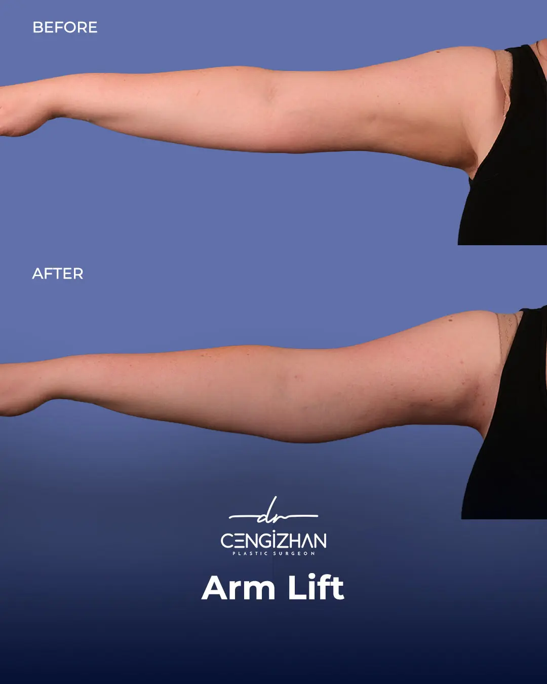 Arm Lift Results Before and After by Dr. Cengizhan Ekizceli