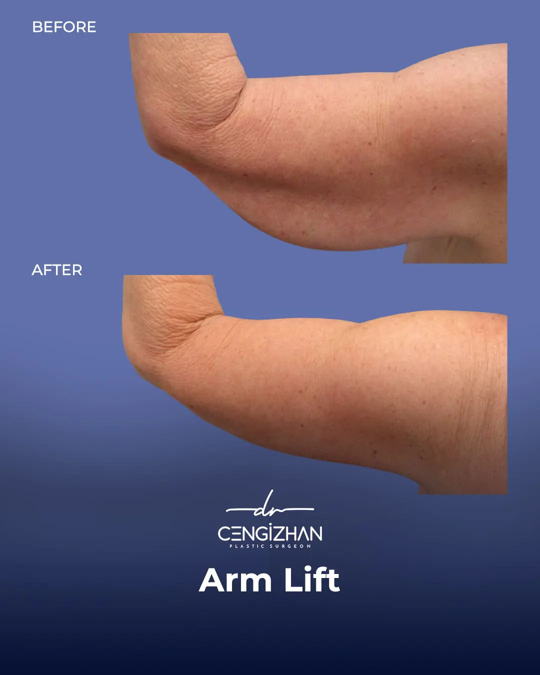 Arm Lift Results Before and After by Dr. Cengizhan Ekizceli