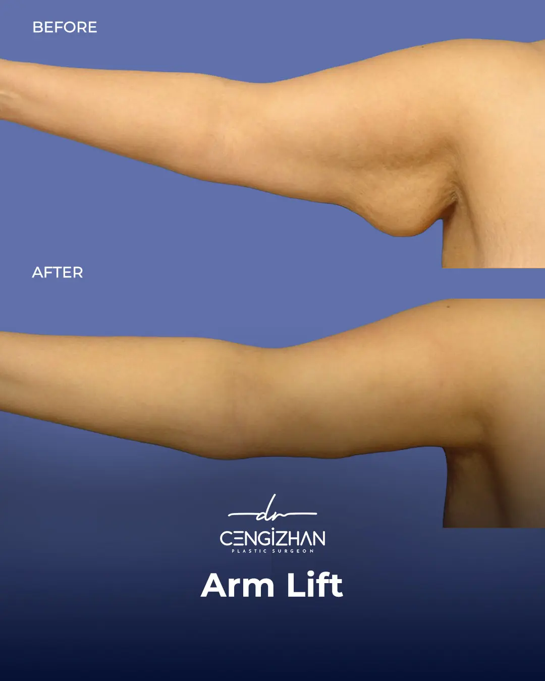 Arm Lift Results Before and After by Dr. Cengizhan Ekizceli