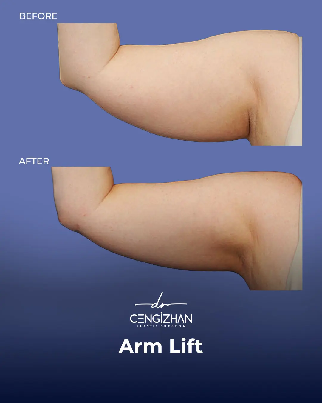 Arm Lift Results Before and After by Dr. Cengizhan Ekizceli