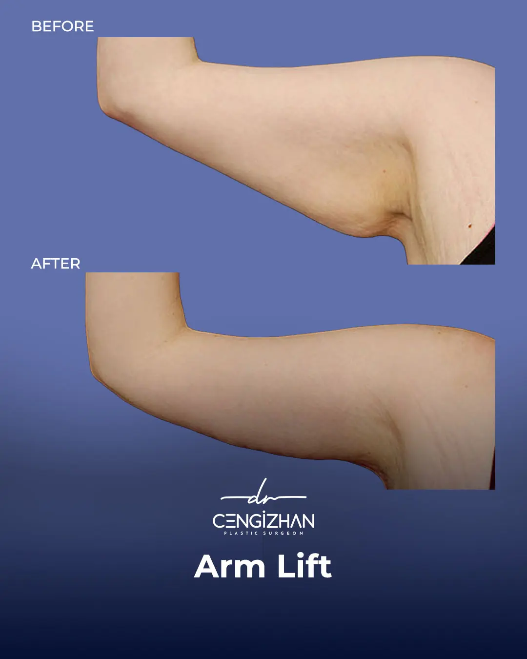 Arm Lift Results Before and After by Dr. Cengizhan Ekizceli