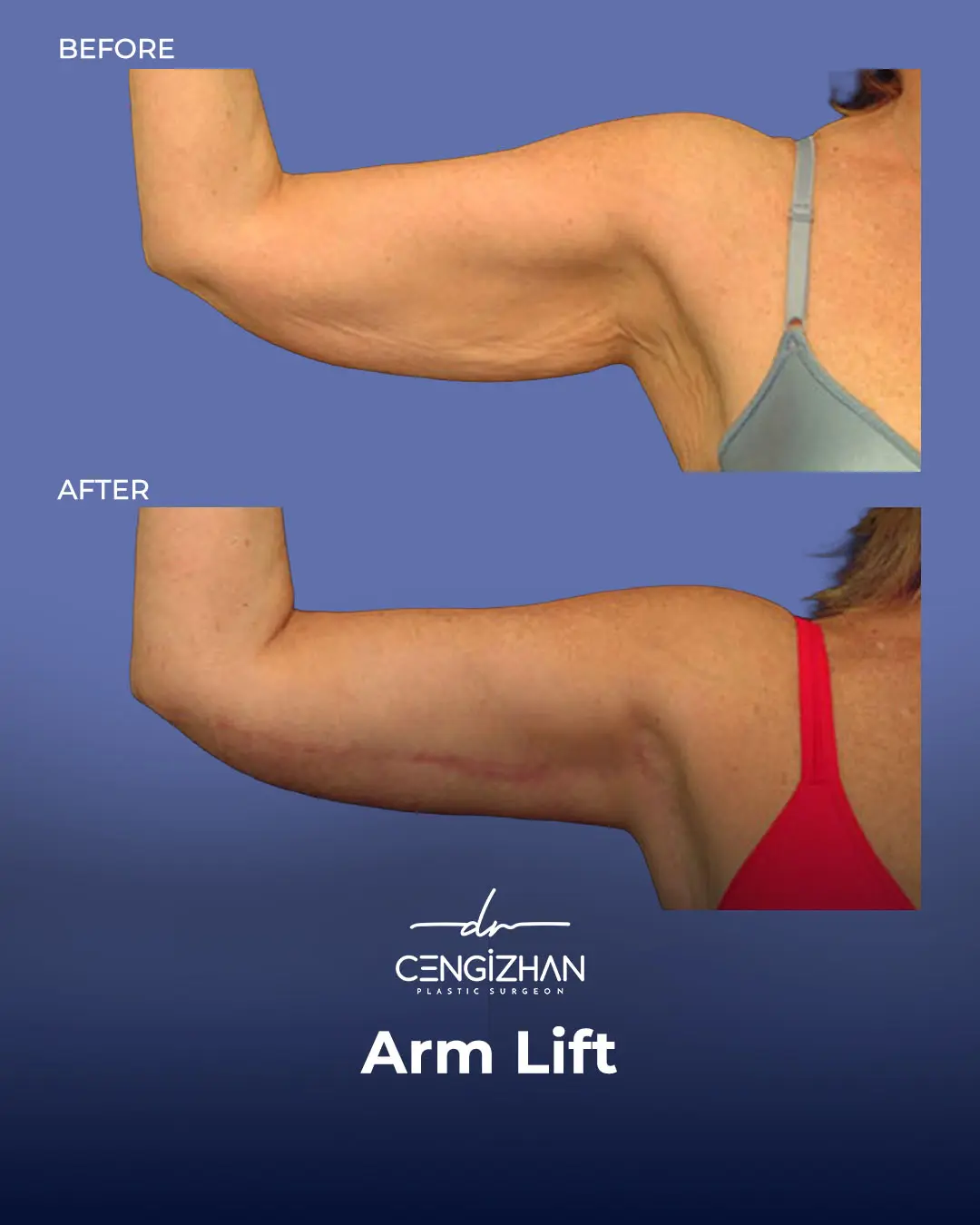 Arm Lift Results Before and After by Dr. Cengizhan Ekizceli