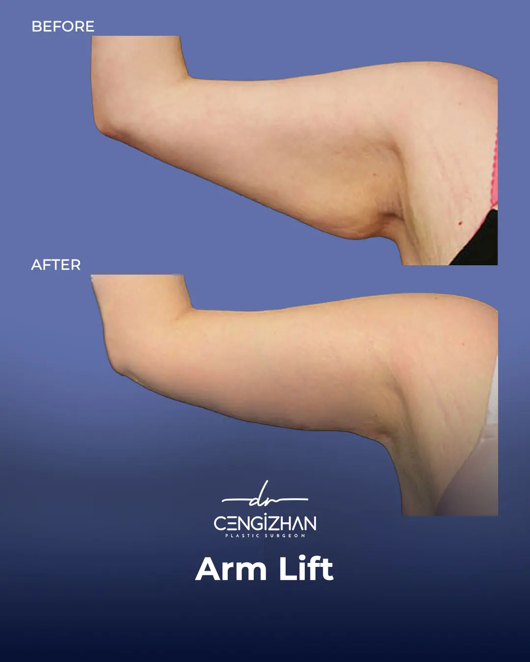 Arm Lift Results Before and After by Dr. Cengizhan Ekizceli