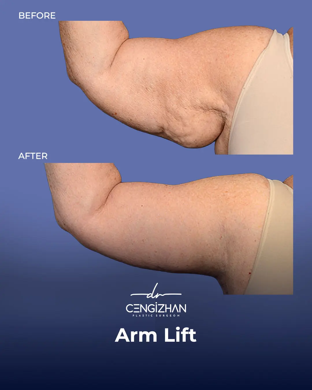 Arm Lift Results Before and After by Dr. Cengizhan Ekizceli