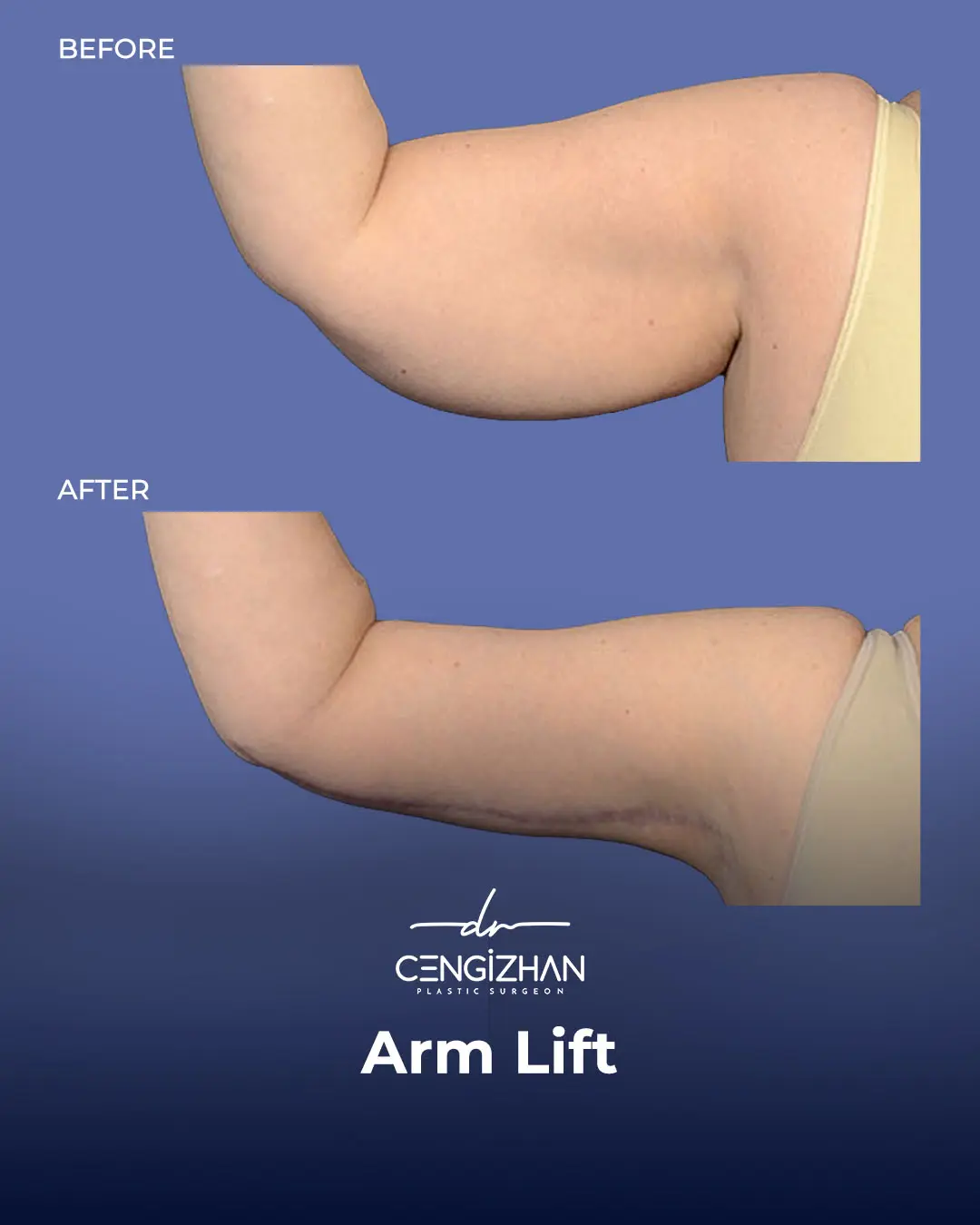 Arm Lift Results Before and After by Dr. Cengizhan Ekizceli