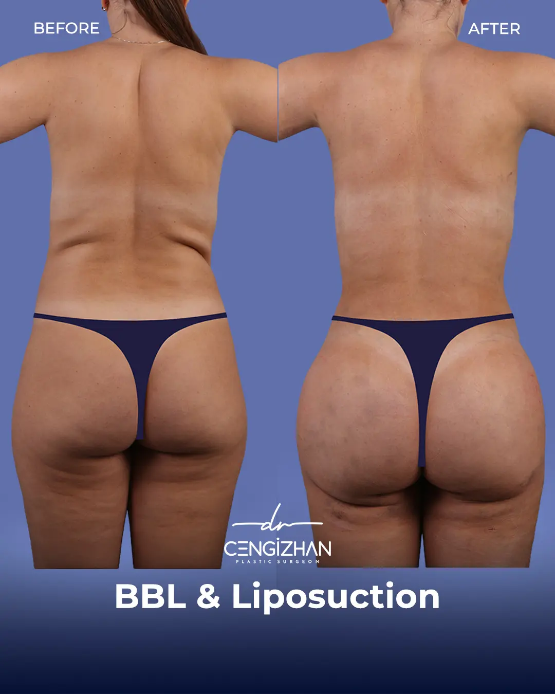 BBL Before and After - Real Patient Results by Dr. Cengizhan Ekizceli