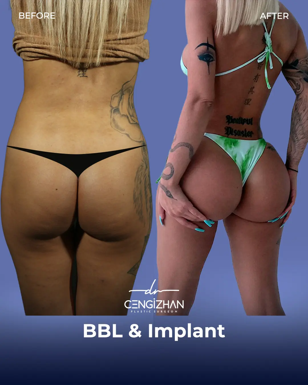 BBL Before and After - Real Patient Results by Dr. Cengizhan Ekizceli