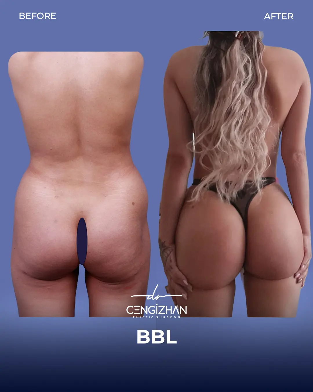 BBL Before and After - Real Patient Results by Dr. Cengizhan Ekizceli