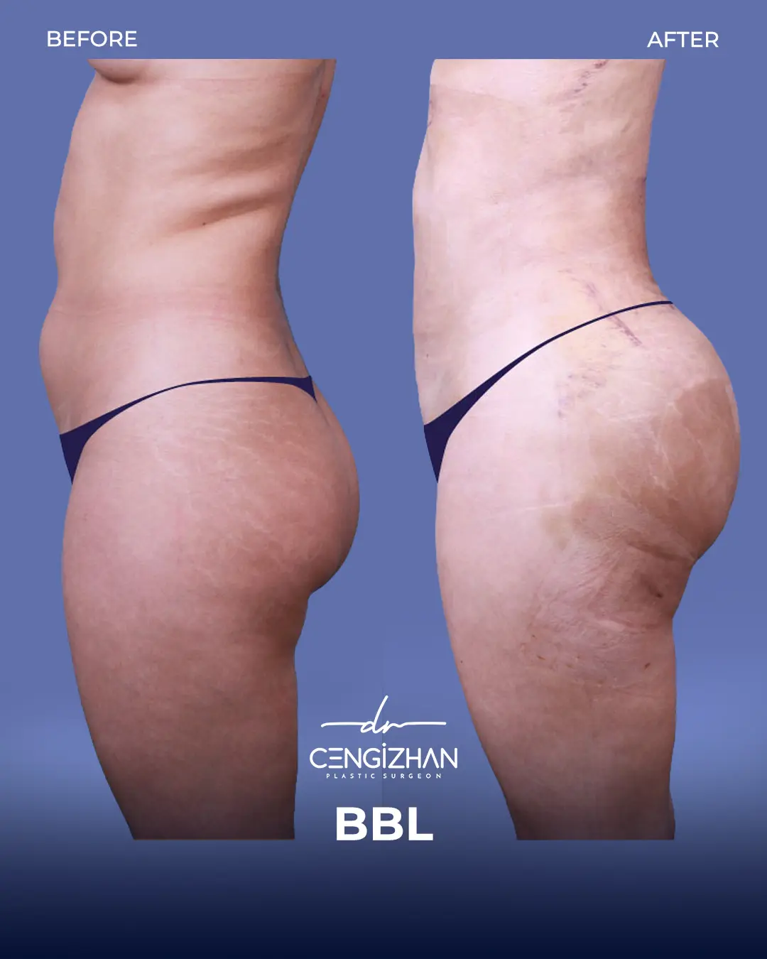 BBL Before and After - Real Patient Results by Dr. Cengizhan Ekizceli