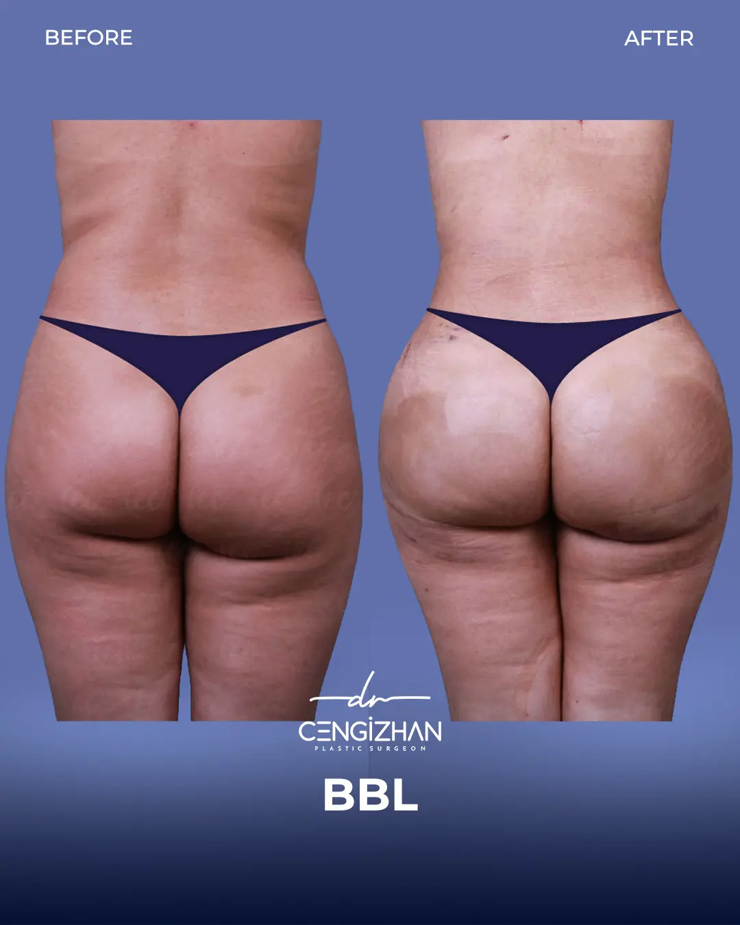 BBL Before and After - Real Patient Results by Dr. Cengizhan Ekizceli