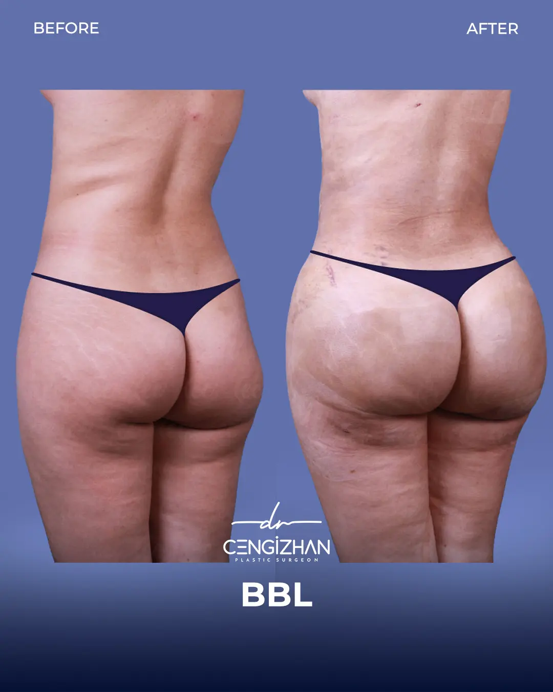 BBL Before and After - Real Patient Results by Dr. Cengizhan Ekizceli