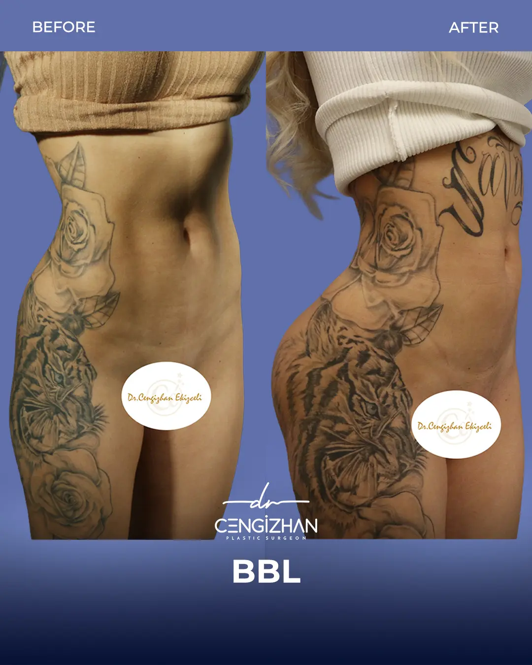 BBL Before and After - Real Patient Results by Dr. Cengizhan Ekizceli