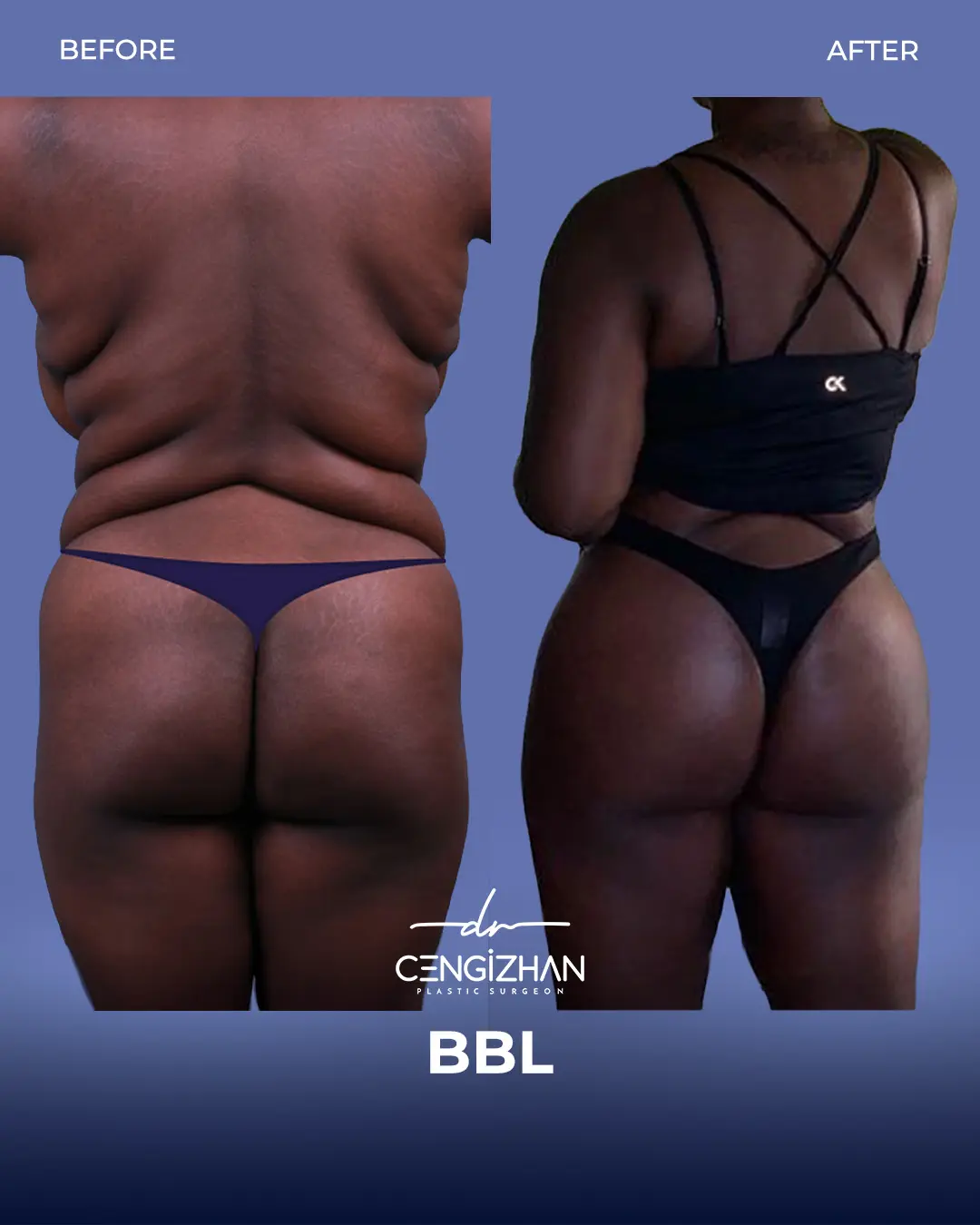 BBL Before and After - Real Patient Results by Dr. Cengizhan Ekizceli