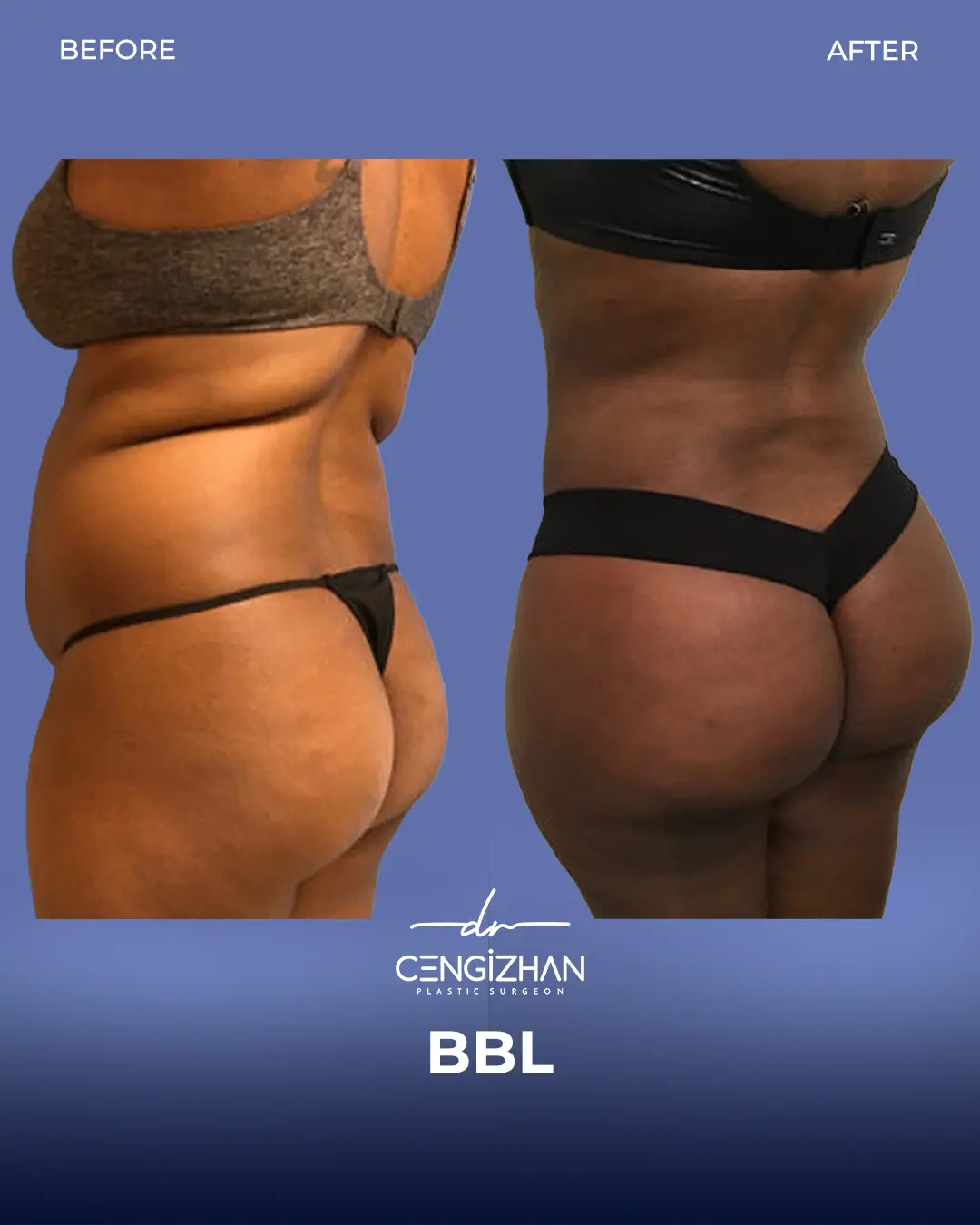 BBL Before and After - Real Patient Results by Dr. Cengizhan Ekizceli