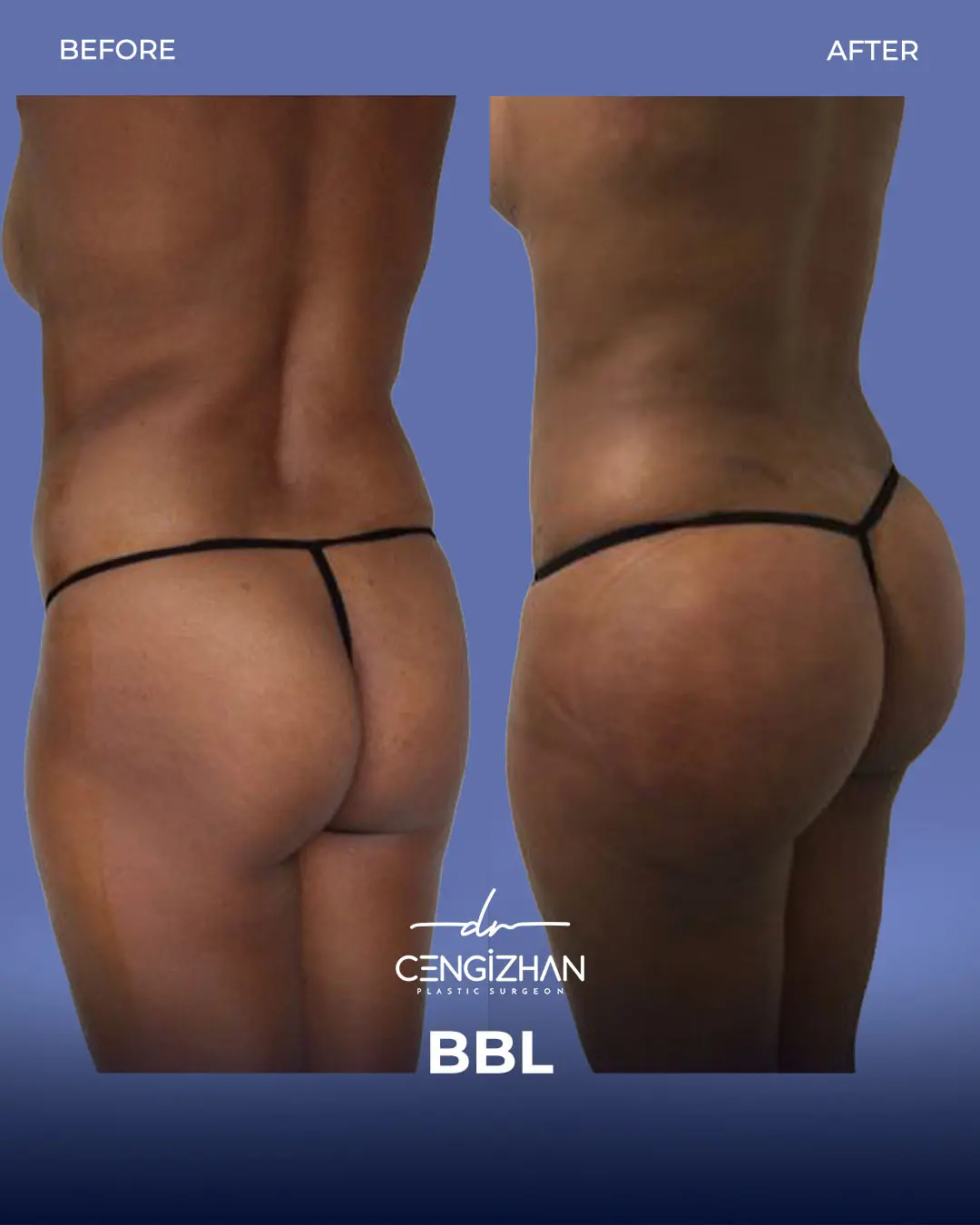 BBL Before and After - Real Patient Results by Dr. Cengizhan Ekizceli