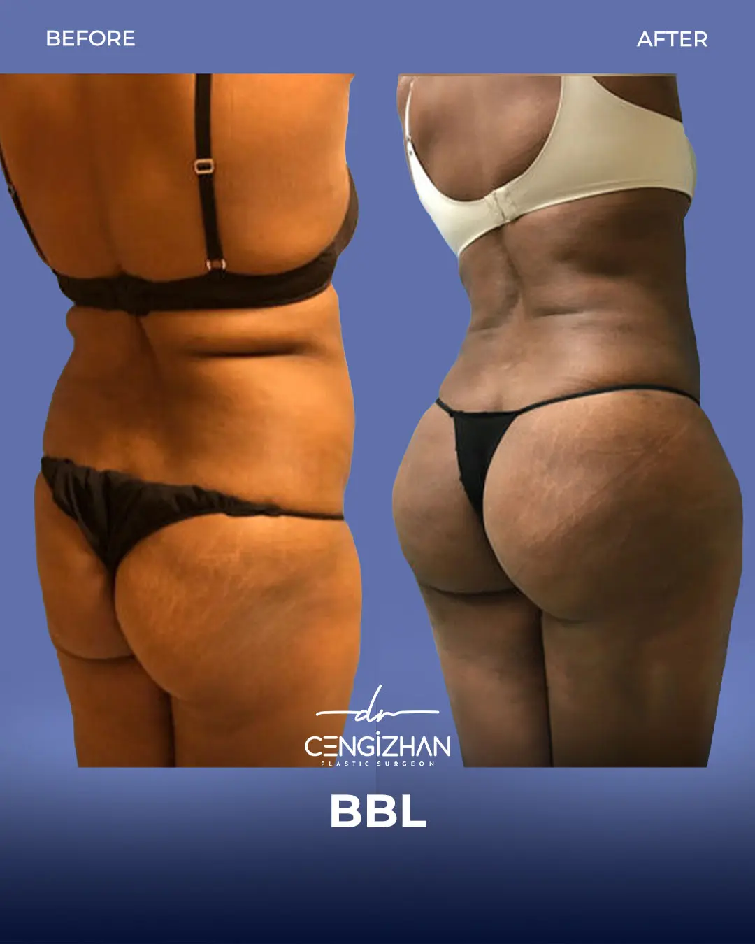 BBL Before and After - Real Patient Results by Dr. Cengizhan Ekizceli