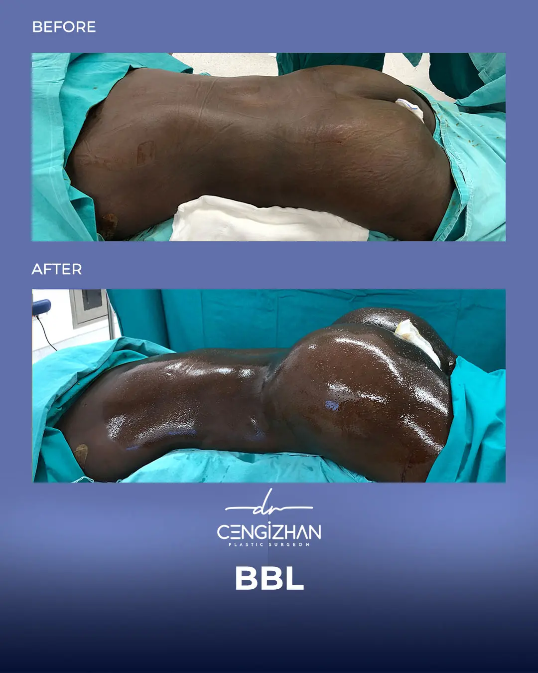BBL Before and After - Real Patient Results by Dr. Cengizhan Ekizceli