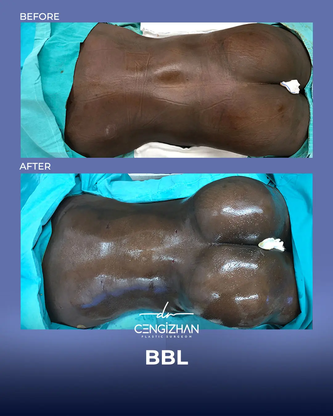 BBL Before and After - Real Patient Results by Dr. Cengizhan Ekizceli