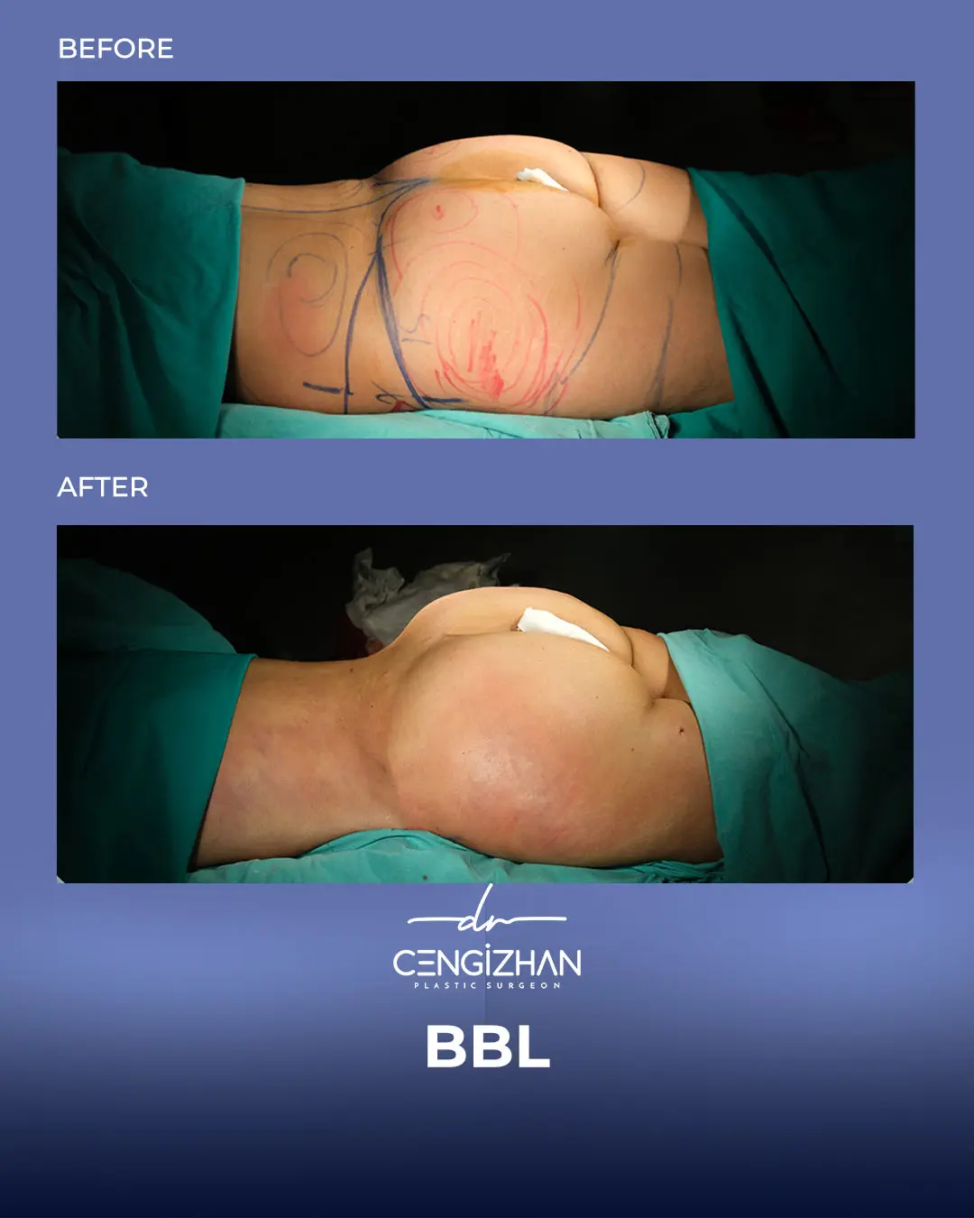 BBL Before and After - Real Patient Results by Dr. Cengizhan Ekizceli