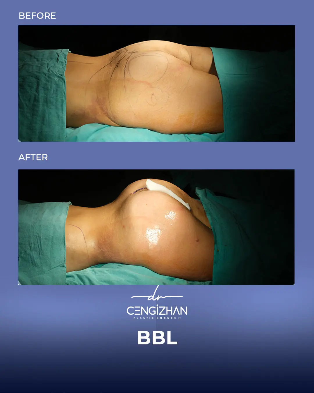 BBL Before and After - Real Patient Results by Dr. Cengizhan Ekizceli