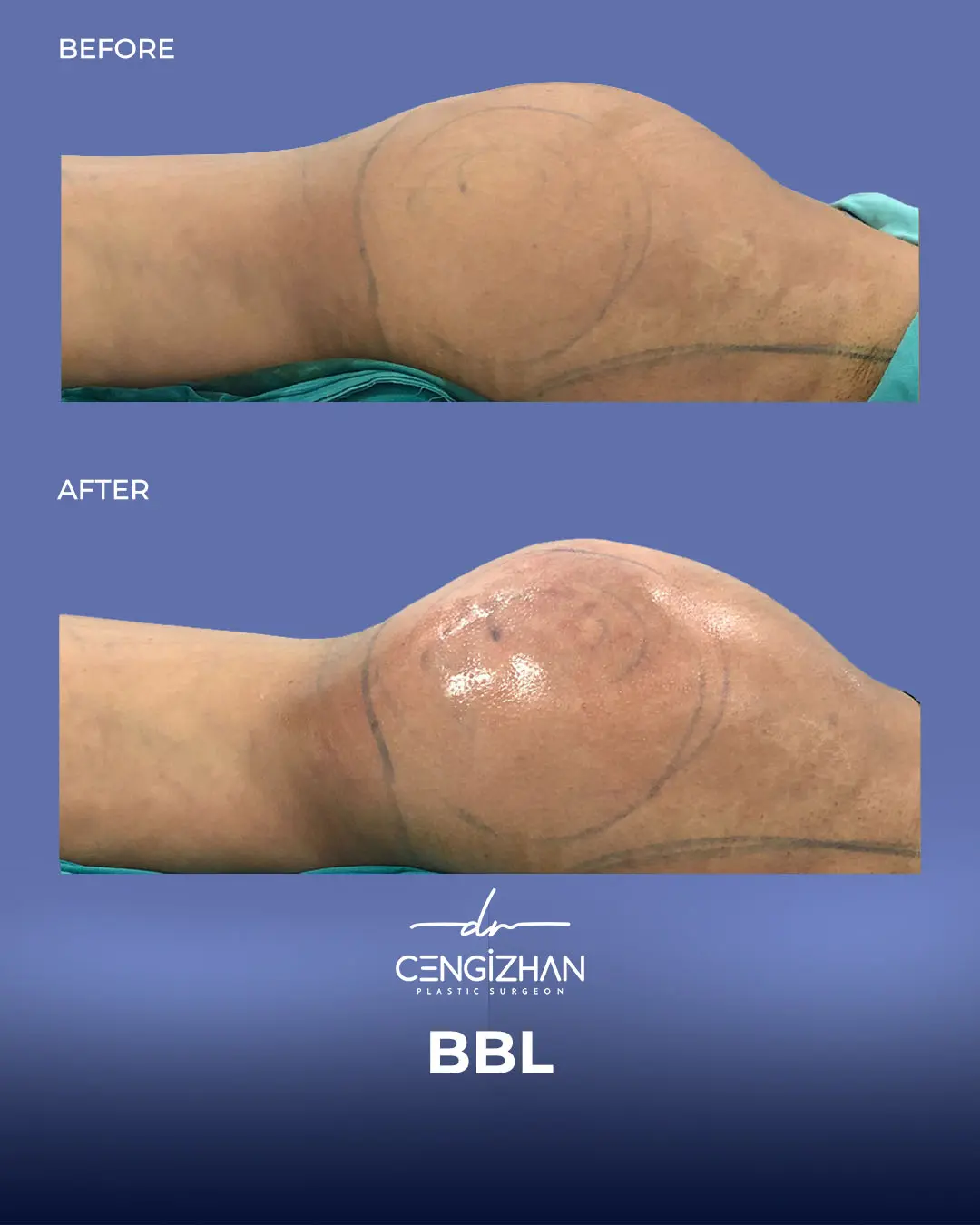 BBL Before and After - Real Patient Results by Dr. Cengizhan Ekizceli