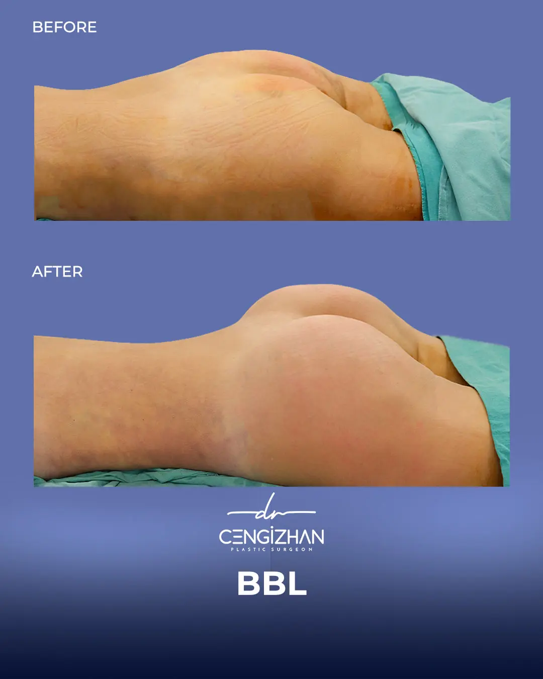 BBL Before and After - Real Patient Results by Dr. Cengizhan Ekizceli