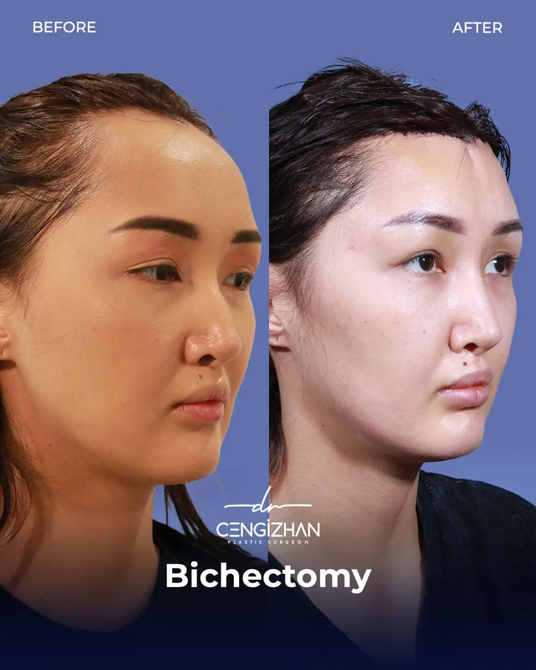 Bichectomy Before and After by Dr. Cengizhan Ekizceli