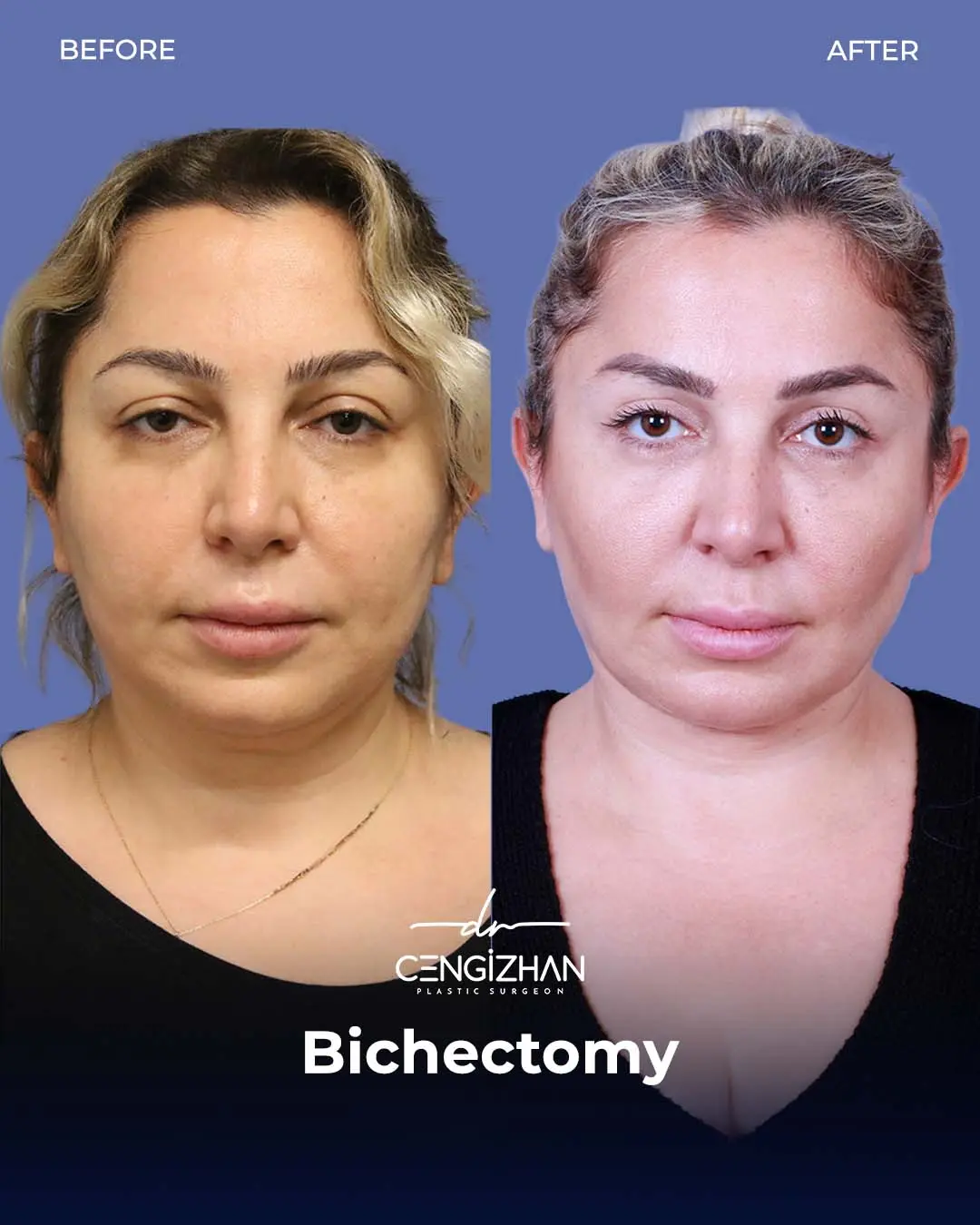 Bichectomy Before and After by Dr. Cengizhan Ekizceli