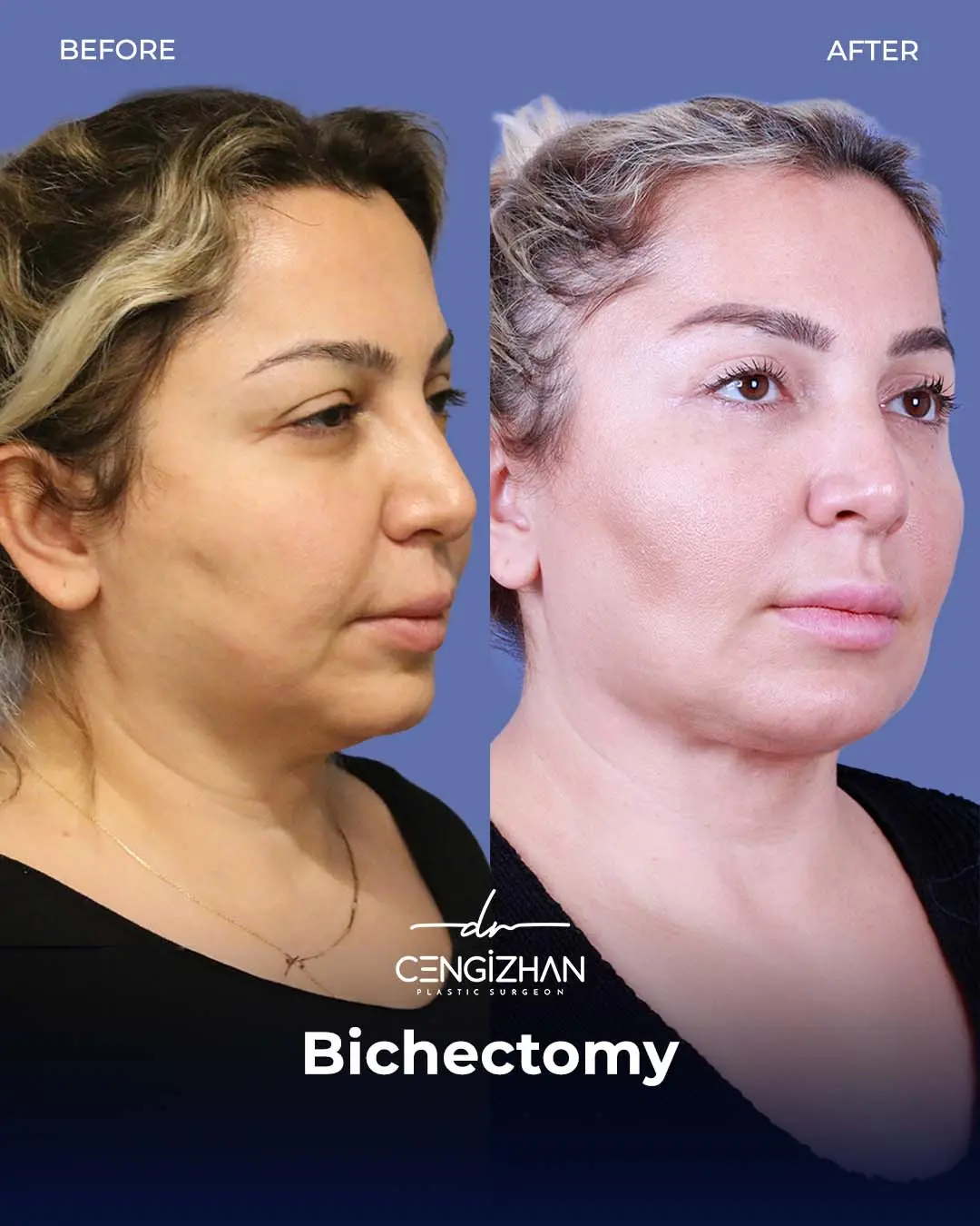 Bichectomy Before and After by Dr. Cengizhan Ekizceli