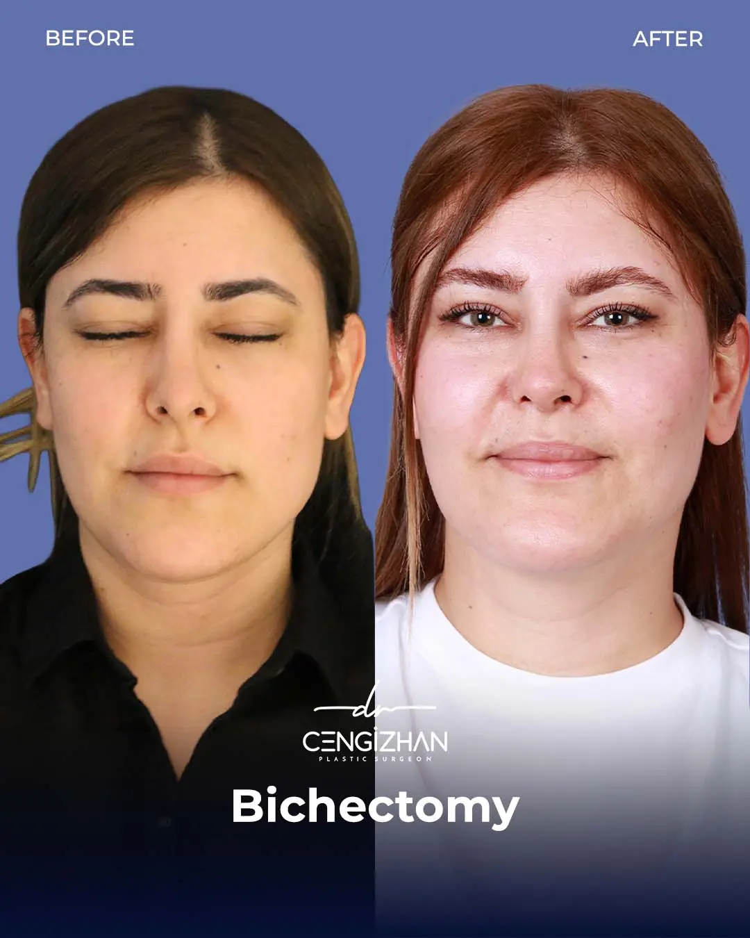 Bichectomy Before and After by Dr. Cengizhan Ekizceli