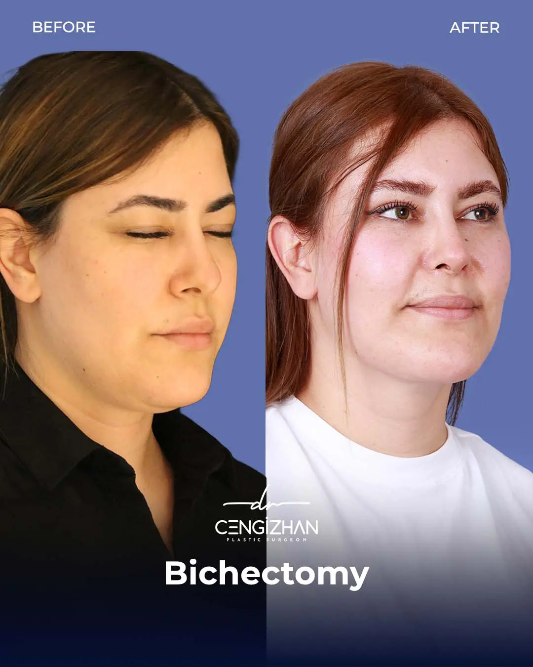 Bichectomy Before and After by Dr. Cengizhan Ekizceli